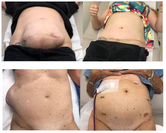 Hernia before and after sugery