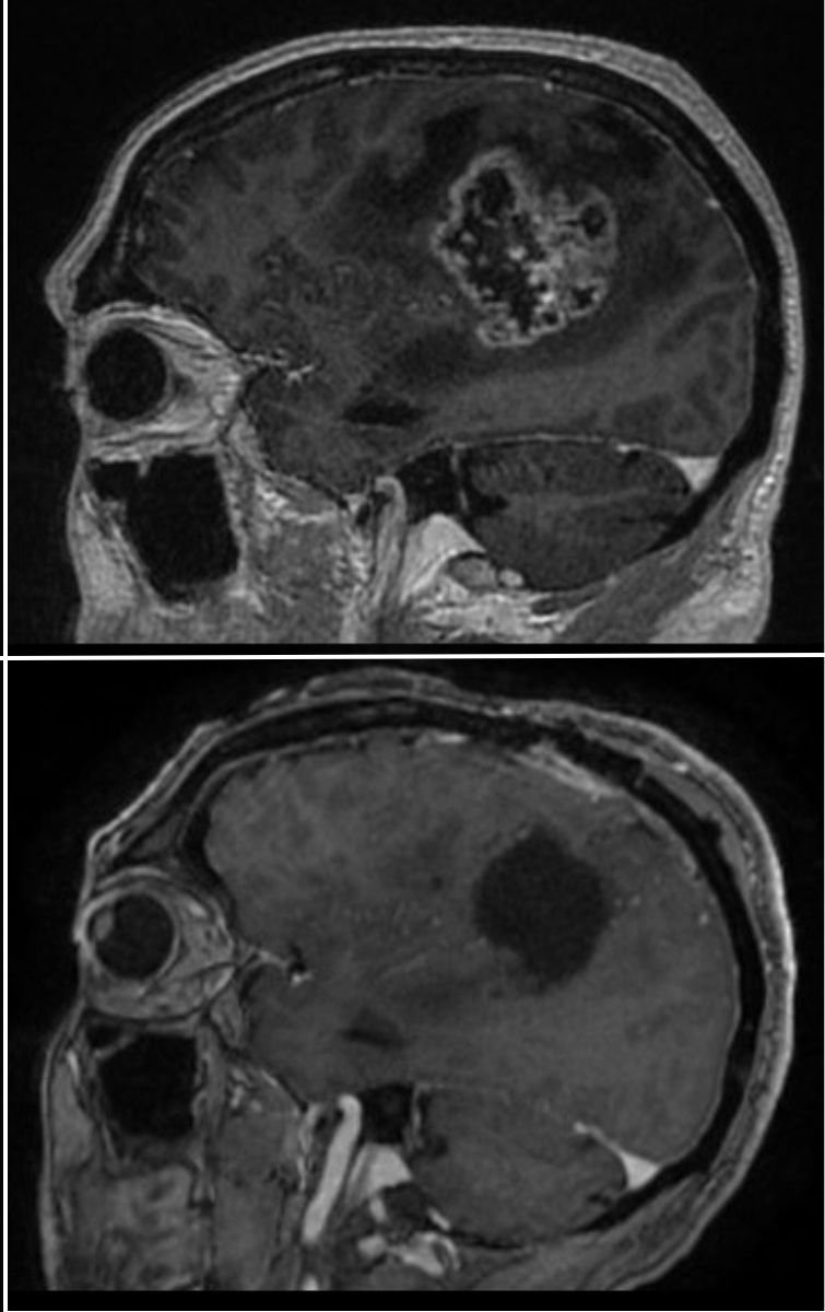 top image showcases MRI scan pre-surgery and the bottom image showcases the void left after a successful removal of 100% of the enhancing tumor