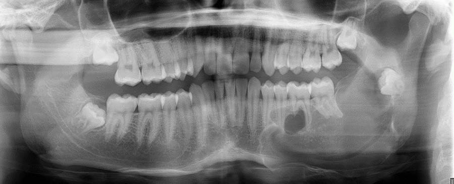 Panoramic dental X‑ray showing the full upper and lower jaw, including teeth and jawbone structure, with visible areas indicating damage or the need for surgical reconstruction