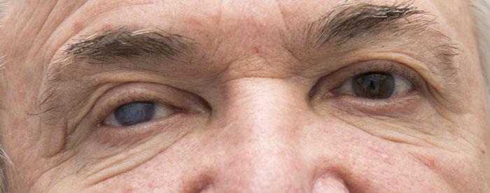 Cataract-Still-Cropped Cataract-Still-Cropped