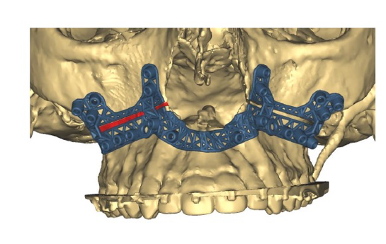 Rendering of jaw to reposition jaw bone