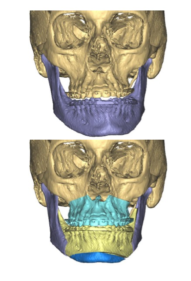 Rendering of Jaw repositioning