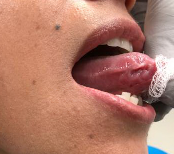 Tongue cleared of venous malformation 