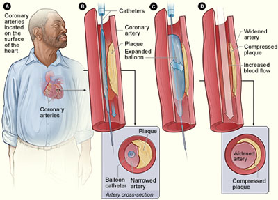 Angiopolasty - image source: NIH