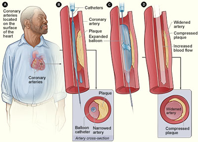 Angiopolasty - image source: NIH