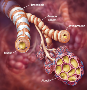 Chronic Bronchitis