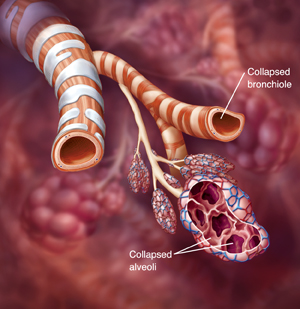 Damage due to Emphysema