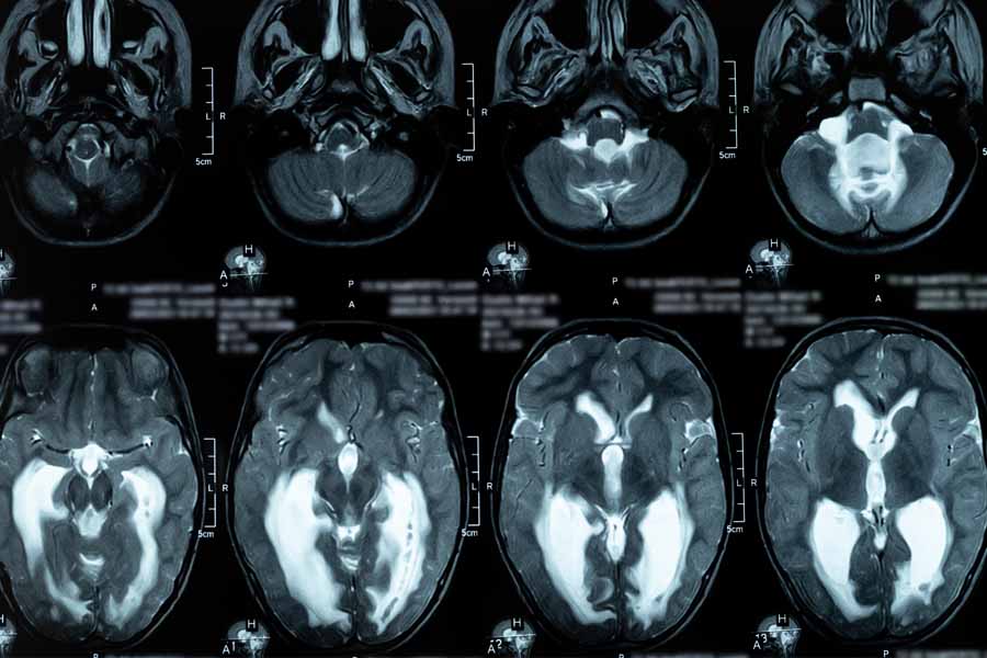 Brain MRI images show ventricular changes used to diagnose hydrocephalus and CSF flow conditions at UTMB Health.
