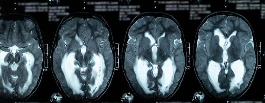 Brain MRI images show ventricular changes used to diagnose hydrocephalus and CSF flow conditions at UTMB Health.
