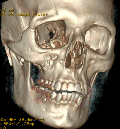 Image of skull with facial fractures