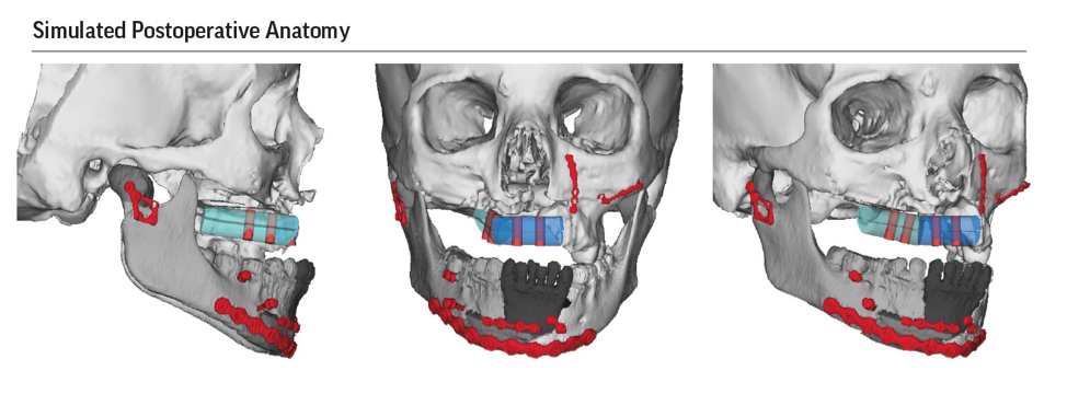 Reconstruction of the face with Microvascular Flap from the Leg using 3D Computer planning Rendering of skull Reconstruction