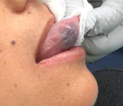 Image of tongue with a Venous Malformation 