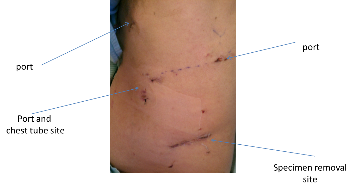 Pneumonectomy (entire lung removed) using VATS - UTMB 2011; click for larger image