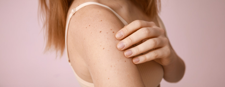 Closeup of woman touching her arm, which has freckles on it