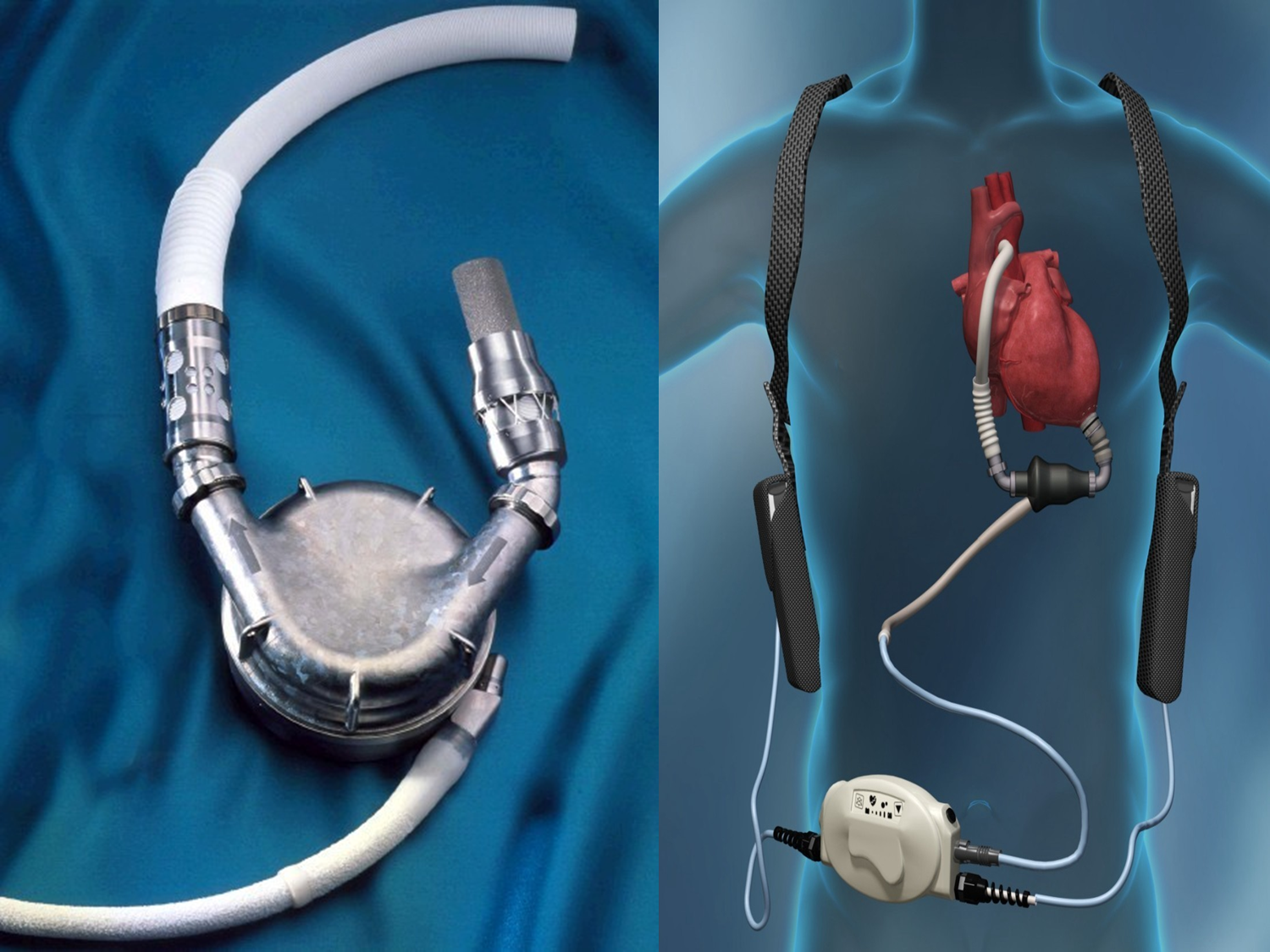 Искусственное сердце аппарат. Искусственный левый желудочек. Имплантация искусственного сердца.