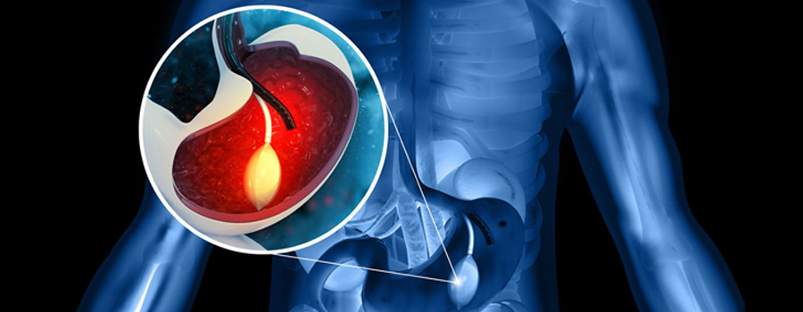 3D illustration of stomach endoscopy, gastric balloon inside a stomach
