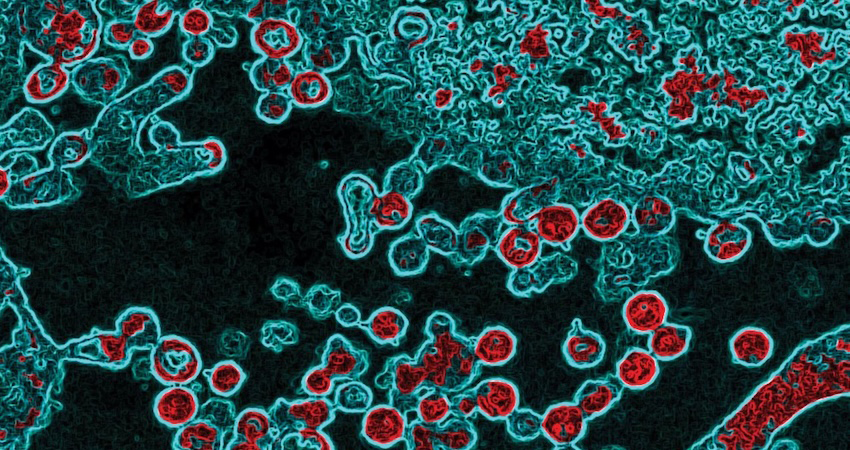 Lassa virus as seen through a microscope